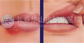 艾滋病疱疹什么样,,艾滋病皮疹_点力图库