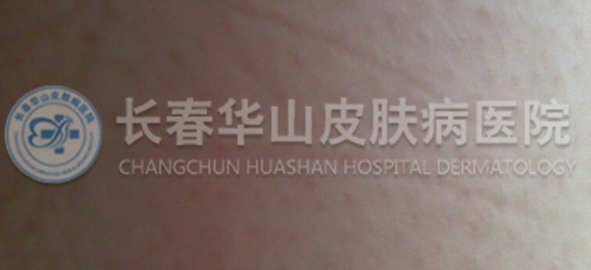 毛周角化