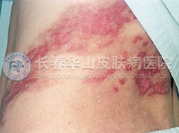皮肤病专家浅谈带状疱疹典型症状