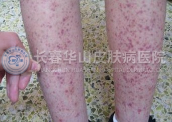 紫癜海鲜_过敏性紫癜_紫癜性皮炎