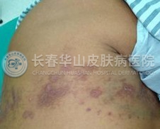 带状疱疹的初期症状